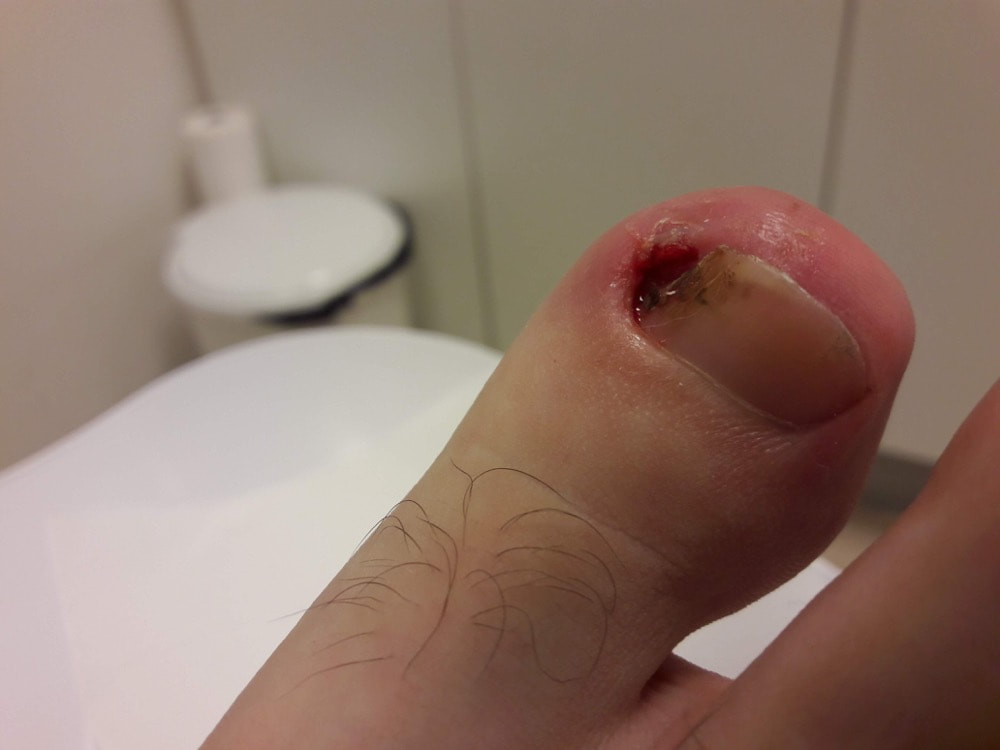 Bloeding onder de nagel