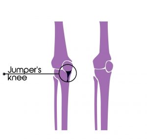 Jumpers knee (springersknie)