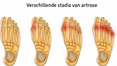 Artrose in de tenen