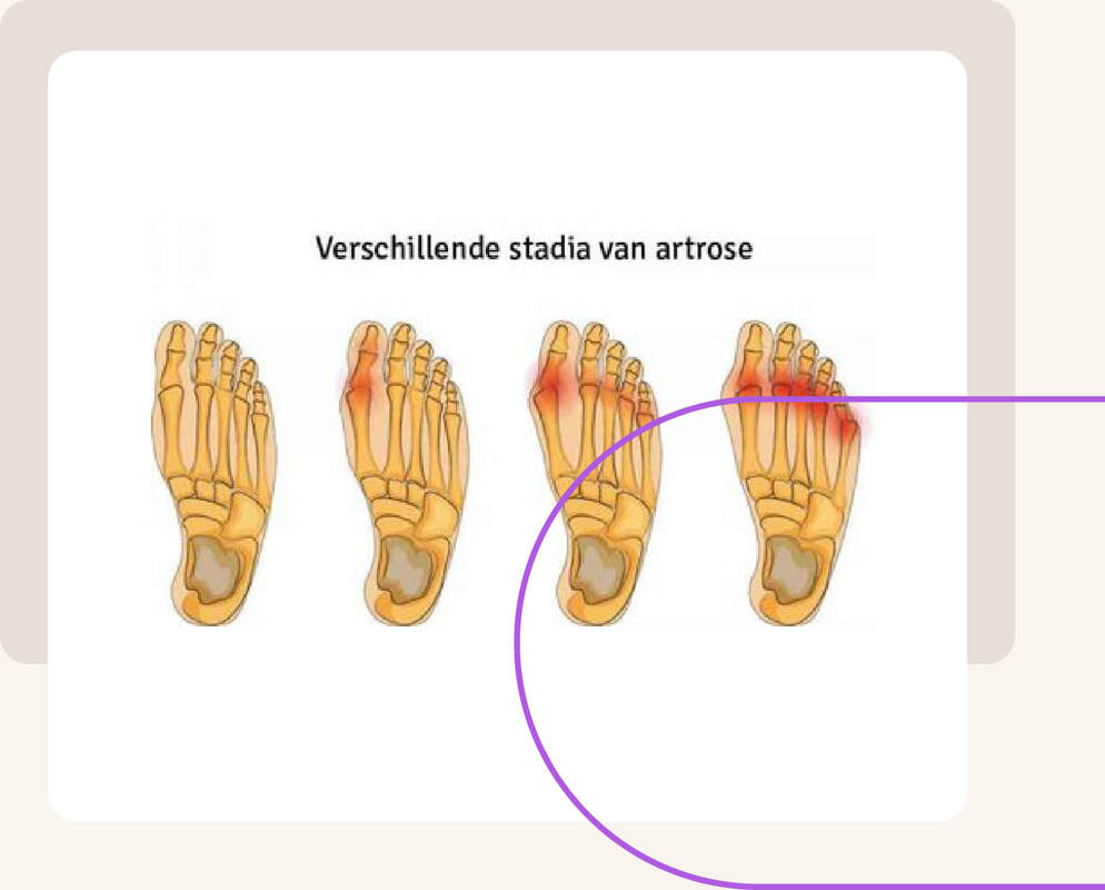 Artrose in de tenen