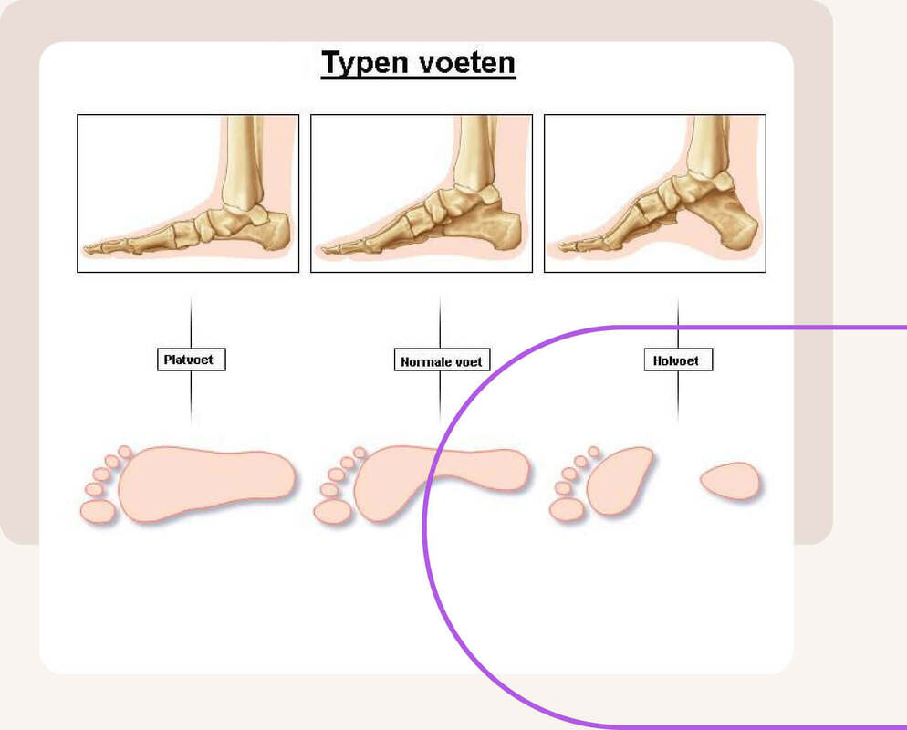 Typen voeten Podotherapie Hermanns