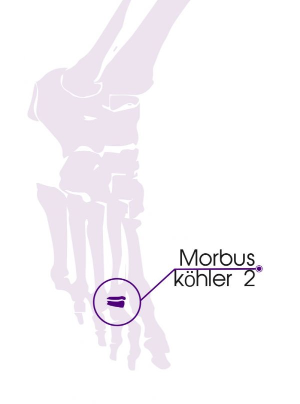 Morbus Köhler 2, pijnlijke tweede teen, tweede middenvoetsbeentje