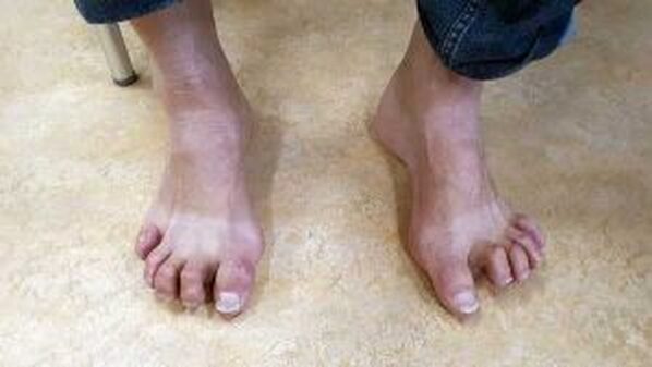 Steunzolen Bij Holvoeten