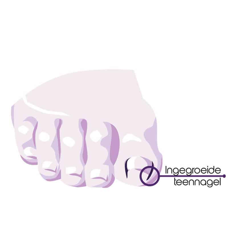 ingegroeide-teennagel