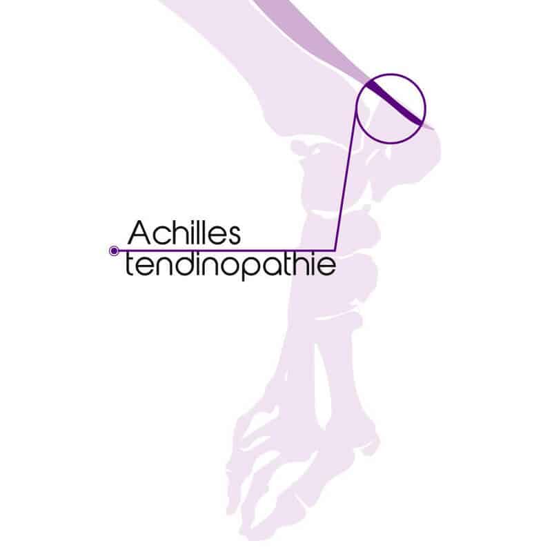 achilles tendinitis