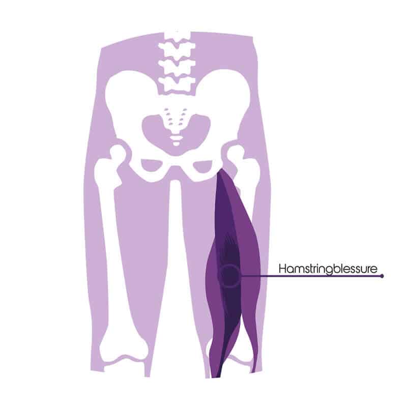 hamstringblessure