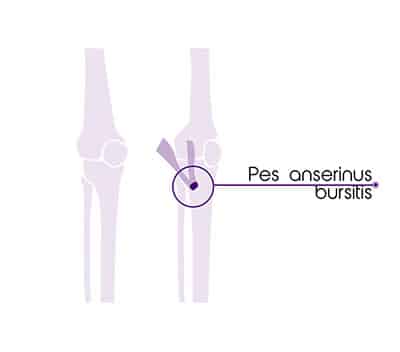 Bursitis-pes-anserinus