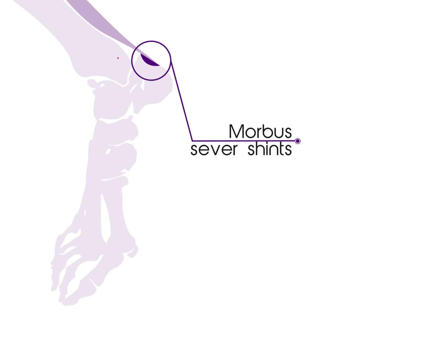 Morbus Sever (Ziekte van Sever)