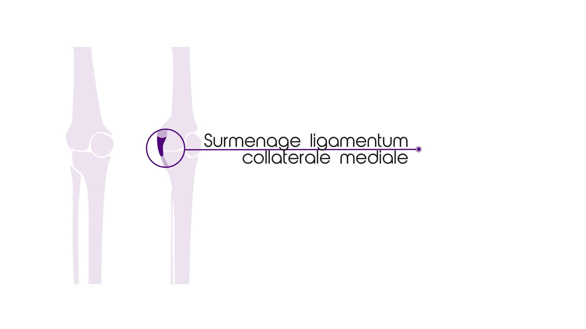 Pijn Aan De Kniebanden