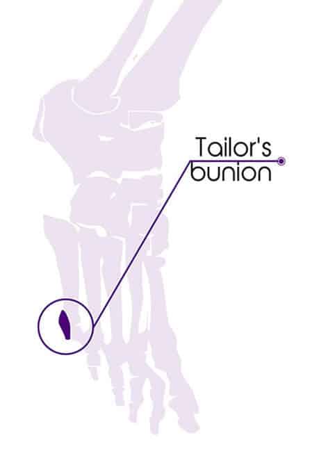 Tailorrsquos Bunion Bunionette
