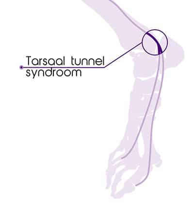 Tarsaal Tunnel Syndroom