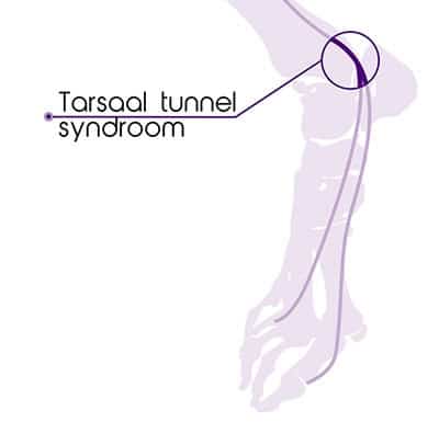 Tarsaal Tunnel Syndroom
