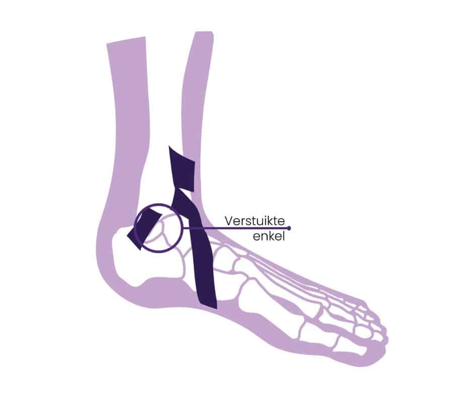 Verstuikte enkel