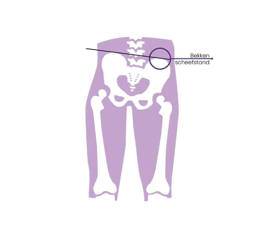 bekkenscheefstand