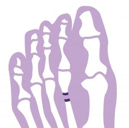 marsfractuur stressfractuur